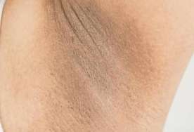 Qolaltı qaralmalar -  Necə xilas ola bilərik? - Həkimdən açıqlama