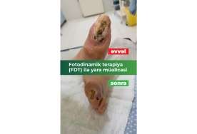 Ayağı kəsilməkdən xilas edən müalicə:  Fotodinamik terapiya (FDT) ilə diabetik yaralarda sürətli sağalma - VİDEO