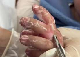 10 aylıq körpə yanıq xəsarəti aldı -  Əlini qaynar çaydana salıb... - VİDEO