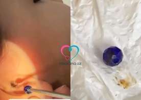 Uşağın qulağından muncuq çıxdı -  Həkimdən xəbərdarlıq-VİDEO