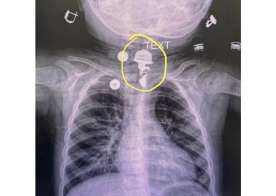 16 aylıq uşaq boyunbağı uddu -  FOTO