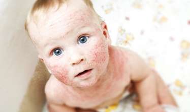 Uşaqlarda allergik dermatit –  Əsrin bəlası