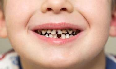 Azərbaycanda uşaqlarda erkən diş çürüməsinin səbəbi   açıqlandı