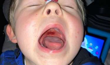 Uşaqlar arasında  "Strep A" infeksiyası yayılır 