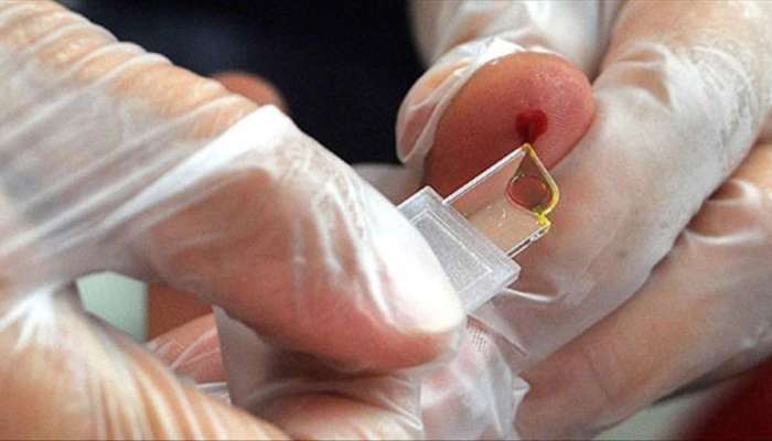 Yeni qan qrupu yaradılır:  Yalnız 50 nəfərdə var