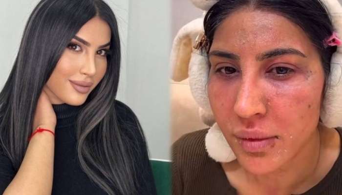 Reklam etdiyi pilinq  Ləmanın üzünü yandırdı