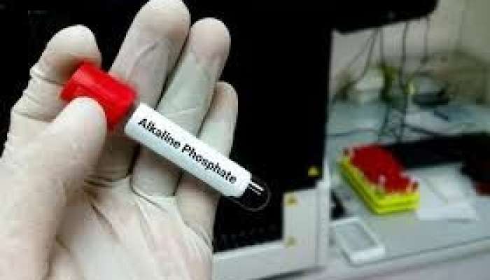 Ümumi qan analizi gizli sümük xəstəliyini göstərir 