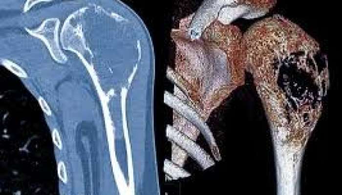 Xərçəngin sümüklərə yayılmasının əlamətləri 