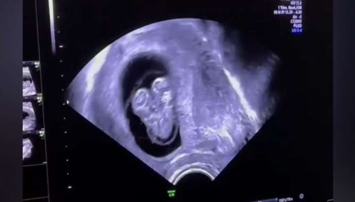 Azərbaycanda hamilədə Siam əkizləri görüldü - Video