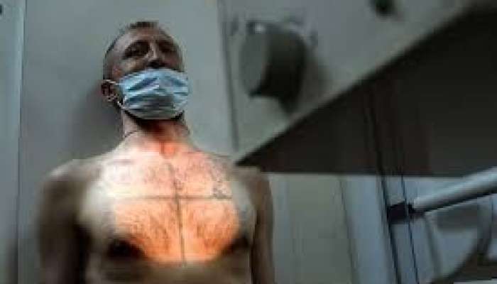 İngiltərədə vərəmdə kəskin artım 