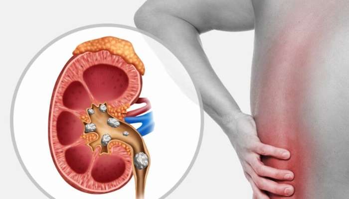 Hər gün bir ovuc yeyin:  Böyrək daşlarını atmağa kömək edir