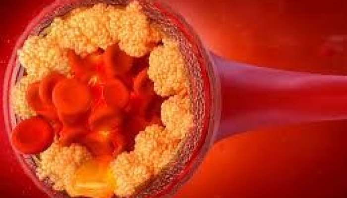 Pis" xolesterolu 60% azaldan dərman kəşf edildi 