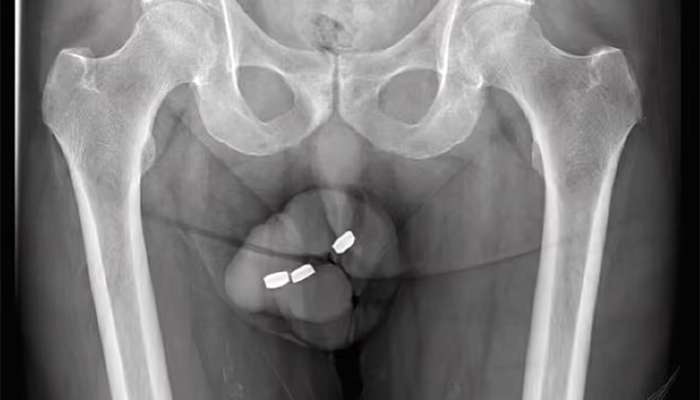 Penisində batareya ilişib qalan kişi     -  əməliyyat olundu