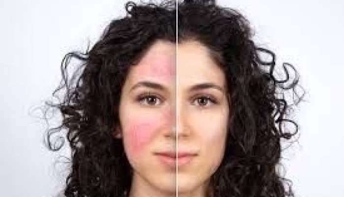 Üzün qızarması bədəndən gələn siqnaldır   - 12 səbəb