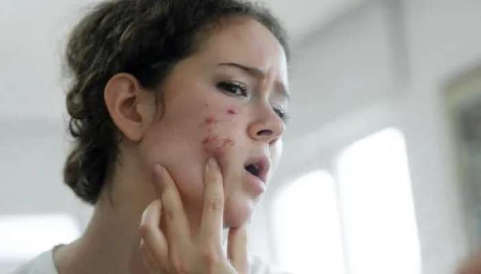 Gecə dəri baxımında  edilən səhv -  Sızanaqlara səbəb olur