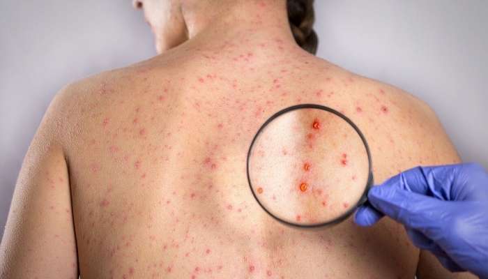 Orta Asiyada sifilis, bruselyoz tüğyan edir 