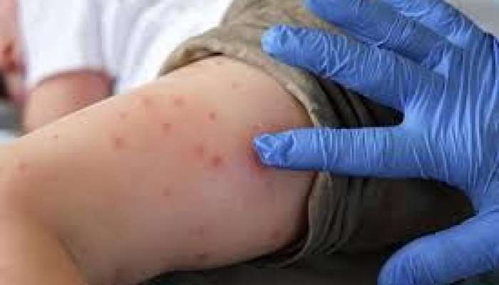 Ermənistanda çikunqunya virusu aşkarlandı 