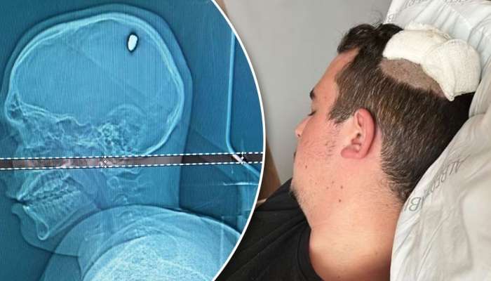 1 sutka başında güllə ilə gəzən kişi    - əməliyyat olundu