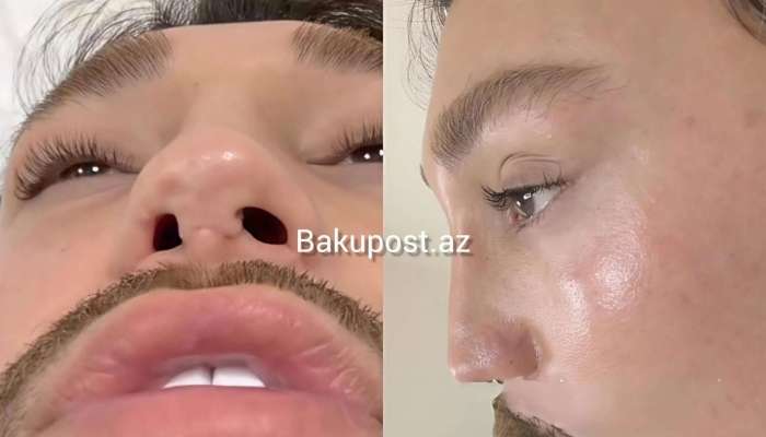 4 dəfə uğursuz əməliyyat etdirən stilist   - Həkimləri ifşa etdi - Adlar