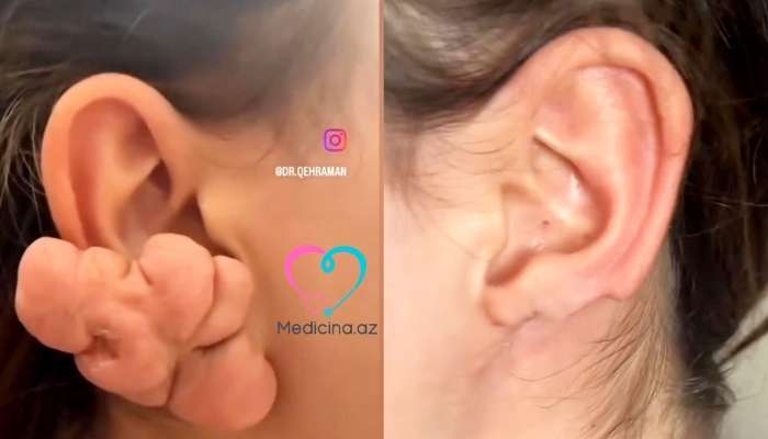 Sırğadan sonra qulağı bu hala düşdü -  VİDEO