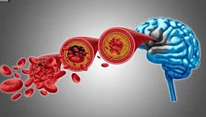 Beyninə qan az gedir?    - Bu əlamətlər varsa...