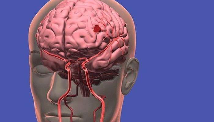 İşemik insultun müalicəsi 60 dəqiqə ərzində başlamalıdır - Nevroloqlar