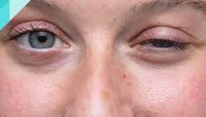 Miasteniya qaraciyərdə yağ yığılmasından    ola bilər