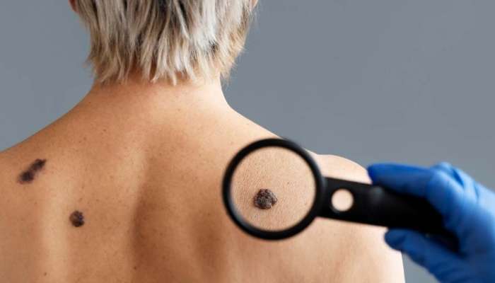 Xalı götürmək xərçəng yaradır? 