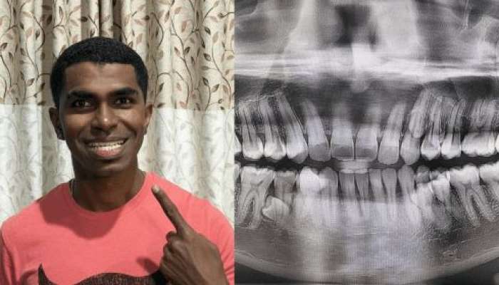 Kişinin ağzında 42 diş çıxıb 