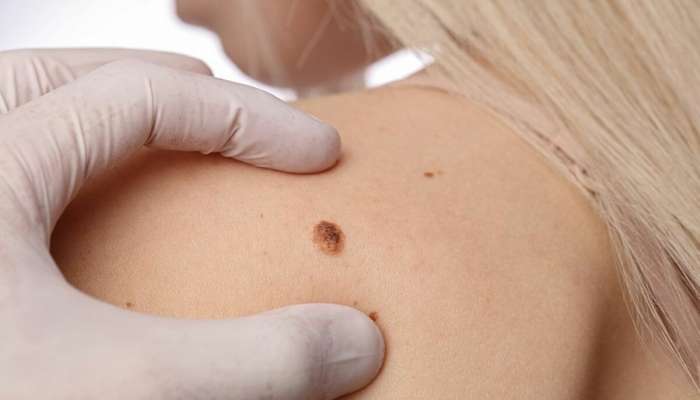 Ət xalları infarkta səbəb olur? 