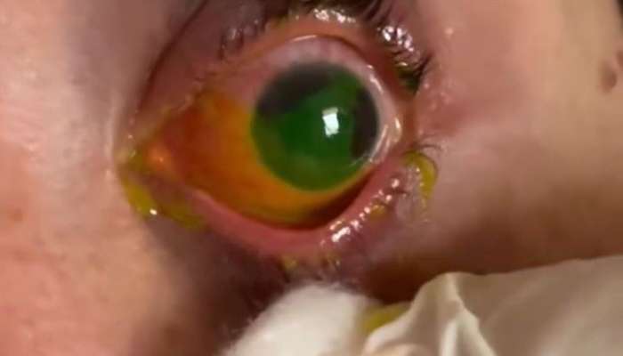 Gözünə potaş məhlulu töküldü, yandı -  VİDEO