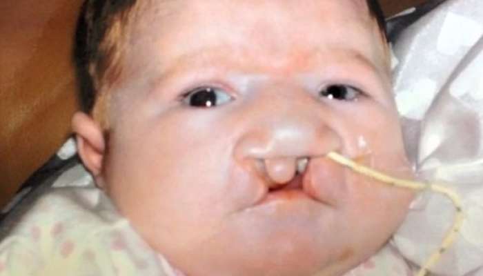 13 mart – Dünya Patau Sindromu günü  – Nadir genetik xəstəlik