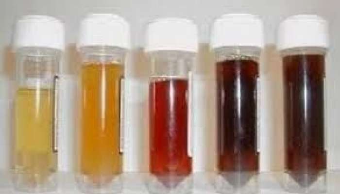 Sidiyin bu rəngi qaraciyərin ağır zədələndiyini göstərir 