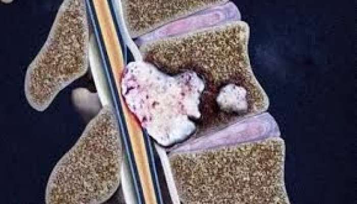 Xərçəngin metastaz verdiyini göstərən    - 5 Əlamət