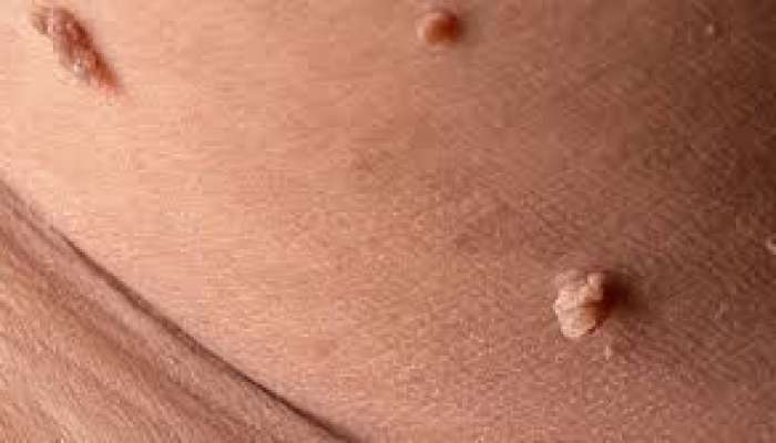 Cinsi orqandakı ziyillər xərçəngə çevrilir? 