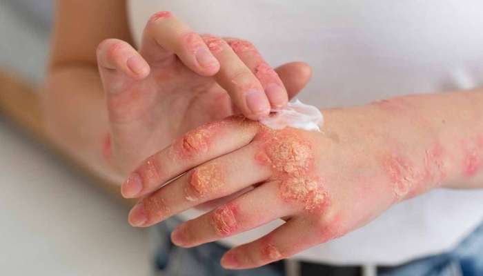 Ekzemaya qarşı krem resepti -  Dərini nəmləndirir