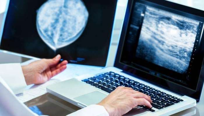 Süd vəzi xərçəngini dəqiq göstərən müayinə 