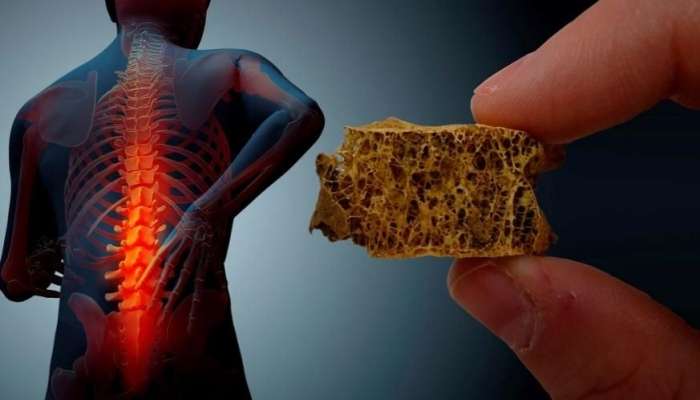  Hər üç kişidən birinin sümükləri zəifdir 