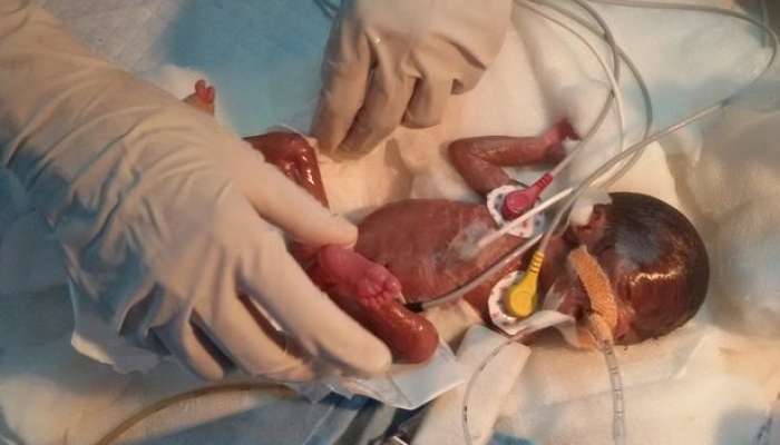 1 kiloqramlıq körpənin ürəyi     əməliyyat olundu