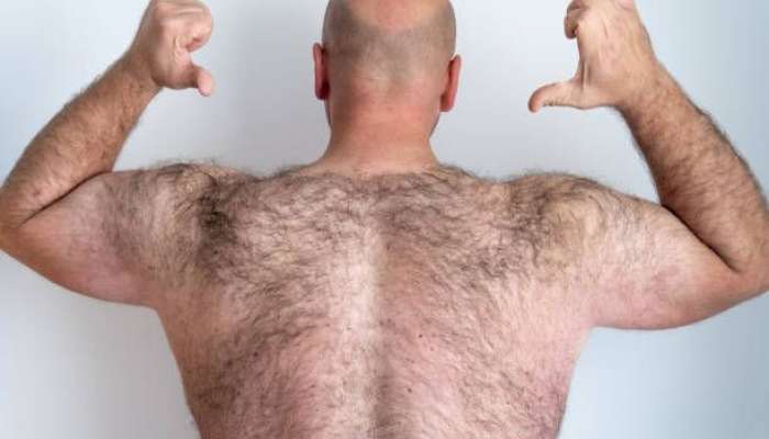 Kişilərdə həddindən artıq tüklənmə  - Səbəblər