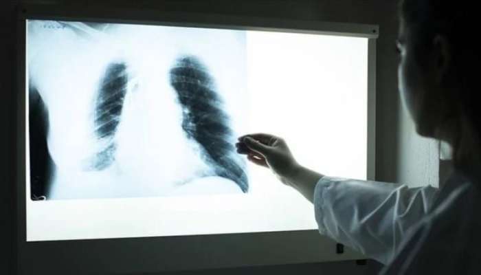 Yoluxma halları artır:  "Ağ vəba" adlanan yeni təhlükə