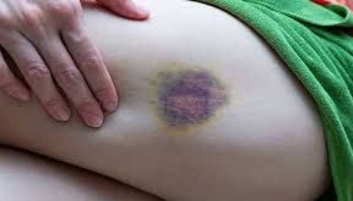 Bədəndə göyərmə, qançırlar sağalmır?   – Bu orqanı yoxlat