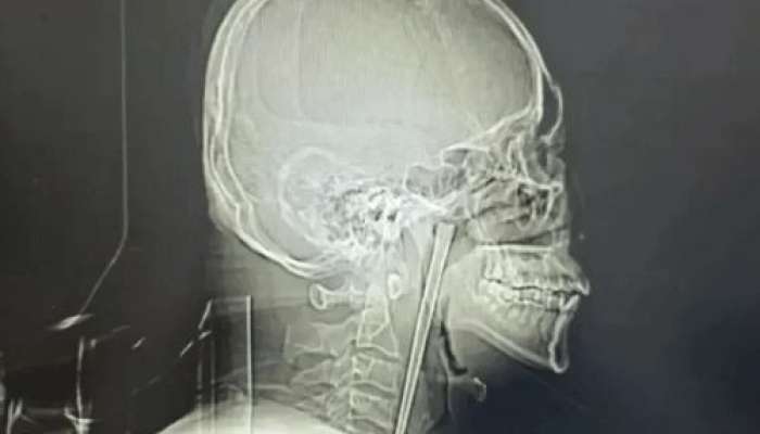 Yemək çubuğunu udan kişi 8 il həkimə getməyib 