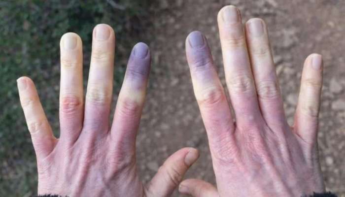 Sadəcə üşüdüyünüzü düşünməyin:  Əlləriniz göyərirsə...