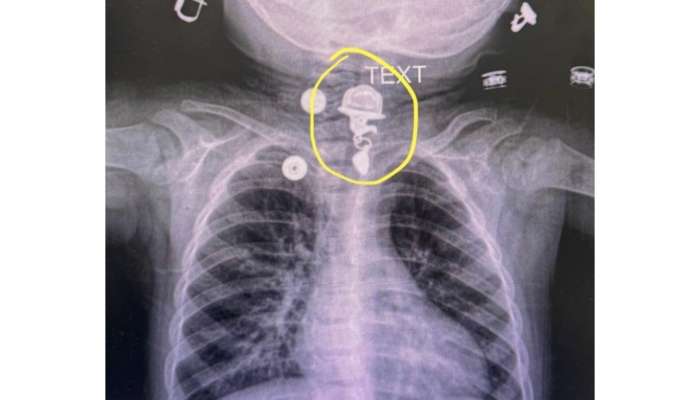 16 aylıq uşaq boyunbağı uddu -  FOTO