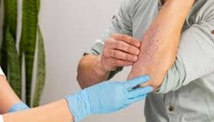 Psoriaz və göbələyin yeni müalicəsi    tapıldı