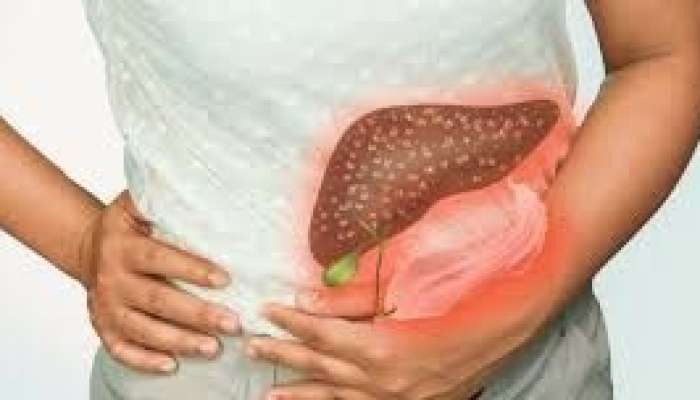 Yaşadığımız yer qaraciyər sirrozu    yarada bilər