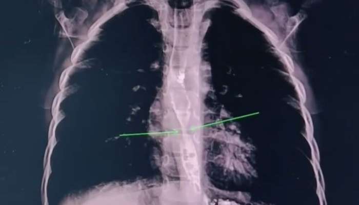 2 yaşlı uşaq yağ çözücü içdi - Daxili orqanları yandı -  VİDEO