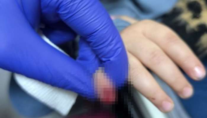 3 yaşlı uşağın əli eskalatorda qaldı -  Barmağı kəsildi