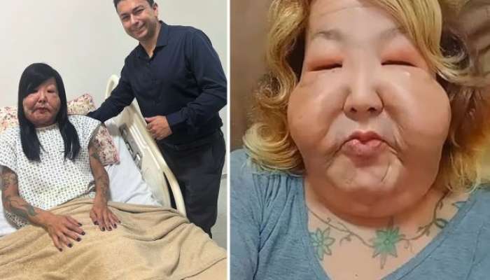 Gözəllik naminə üzü tanınmaz hala gəldi -  FOTO